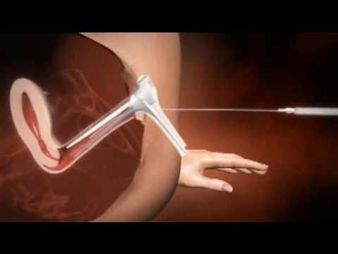 IVF Center in Jaipur